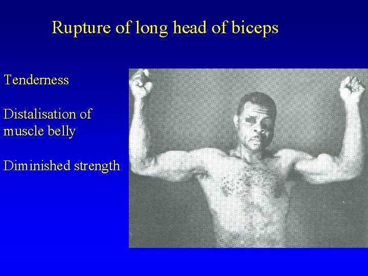 Rupture of long head of biceps Tenderness Distalisation of muscle belly Diminished strength 