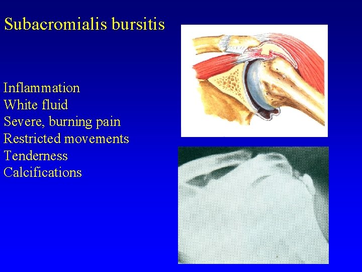 Subacromialis bursitis Inflammation White fluid Severe, burning pain Restricted movements Tenderness Calcifications 