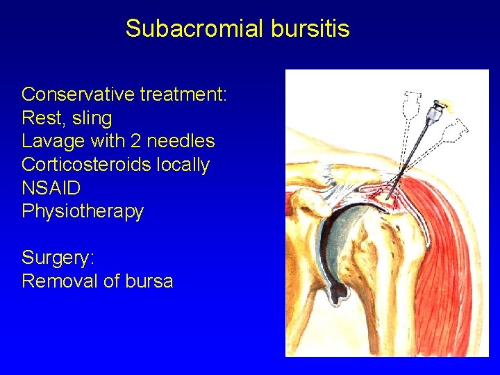 Subacromial bursitis Conservative treatment: Rest, sling Lavage with 2 needles Corticosteroids locally NSAID Physiotherapy