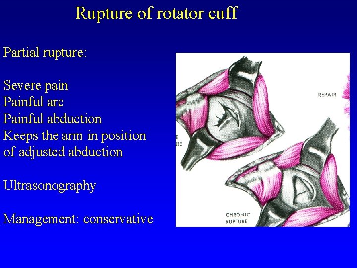 Rupture of rotator cuff Partial rupture: Severe pain Painful arc Painful abduction Keeps the
