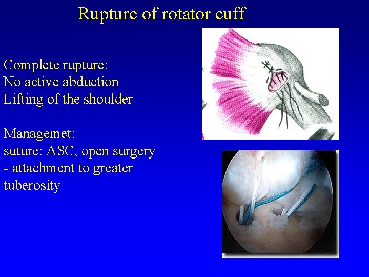 Rupture of rotator cuff Complete rupture: No active abduction Lifting of the shoulder Managemet: