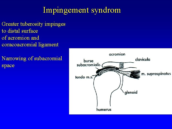 Impingement syndrom Greater tuberosity impinges to distal surface of acromion and coracoacromial ligament Narrowing
