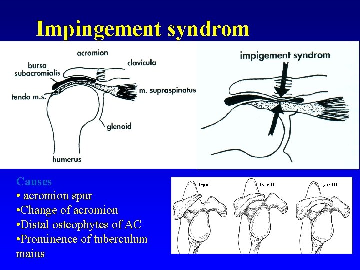 Impingement syndrom Causes • acromion spur • Change of acromion • Distal osteophytes of
