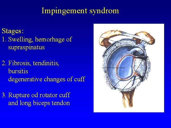 Impingement syndrom Stages: 1. Swelling, hemorhage of supraspinatus 2. Fibrosis, tendinitis, bursitis degenerative changes