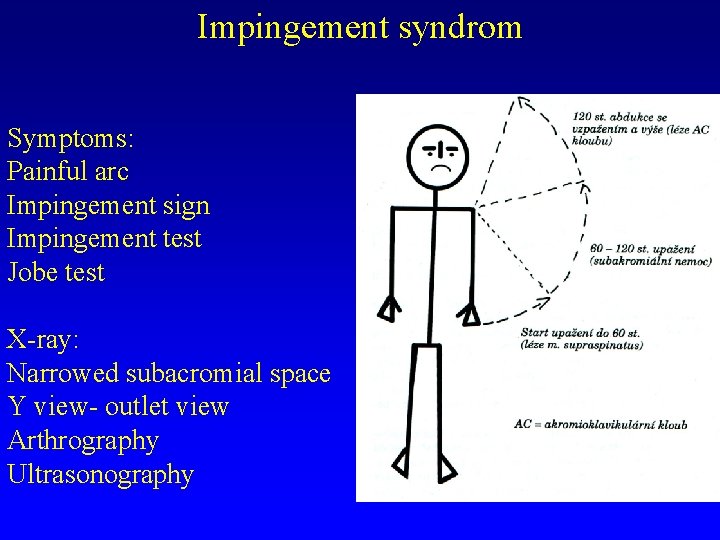 Impingement syndrom Symptoms: Painful arc Impingement sign Impingement test Jobe test X-ray: Narrowed subacromial
