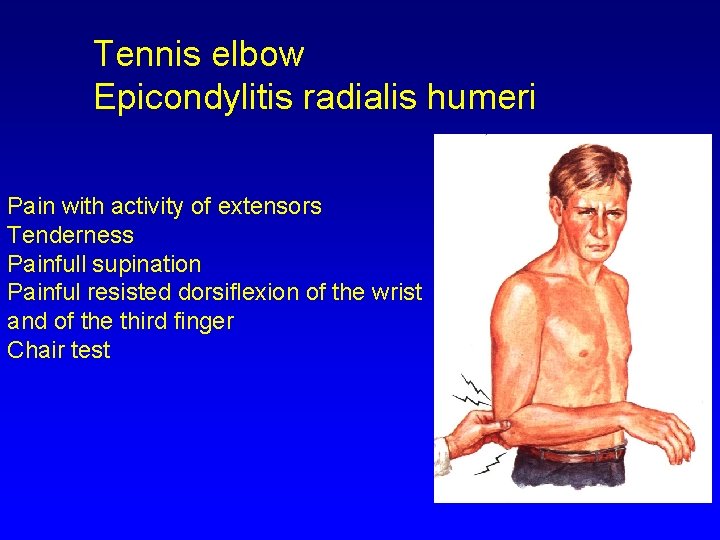 Tennis elbow Epicondylitis radialis humeri Pain with activity of extensors Tenderness Painfull supination Painful