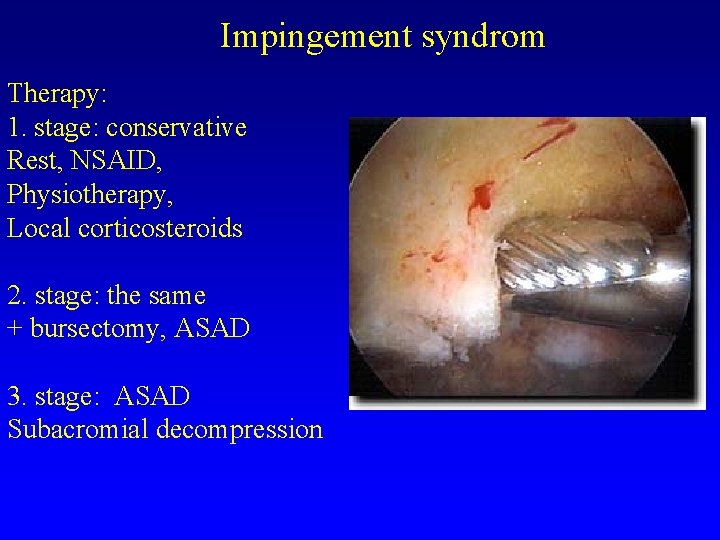 Impingement syndrom Therapy: 1. stage: conservative Rest, NSAID, Physiotherapy, Local corticosteroids 2. stage: the