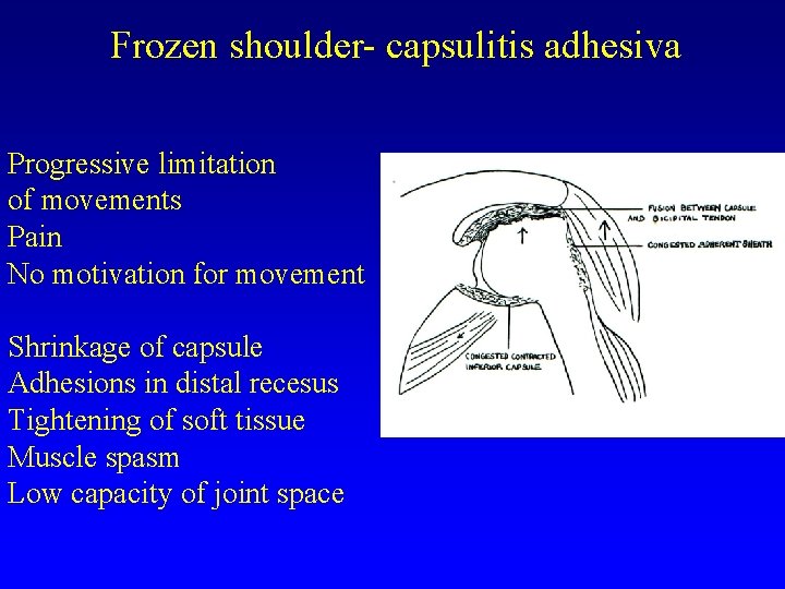 Frozen shoulder- capsulitis adhesiva Progressive limitation of movements Pain No motivation for movement Shrinkage