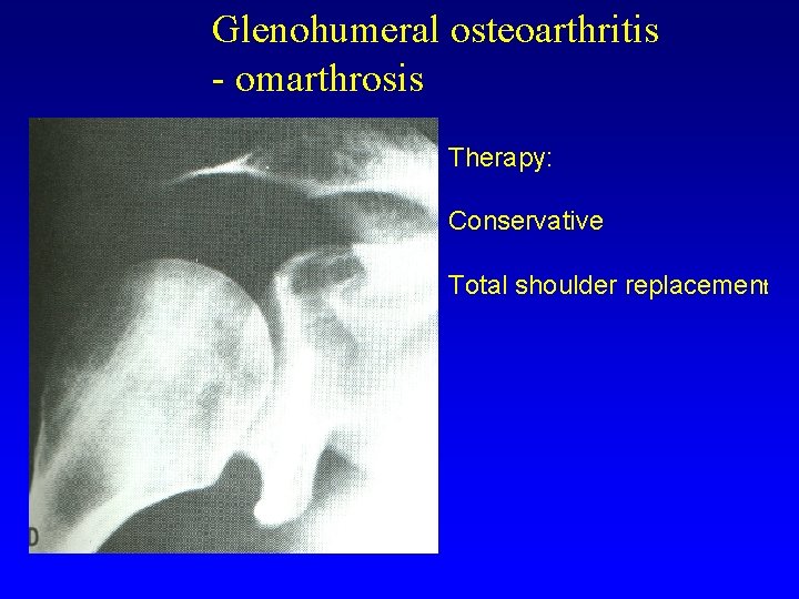 Glenohumeral osteoarthritis - omarthrosis Therapy: Conservative Total shoulder replacement 