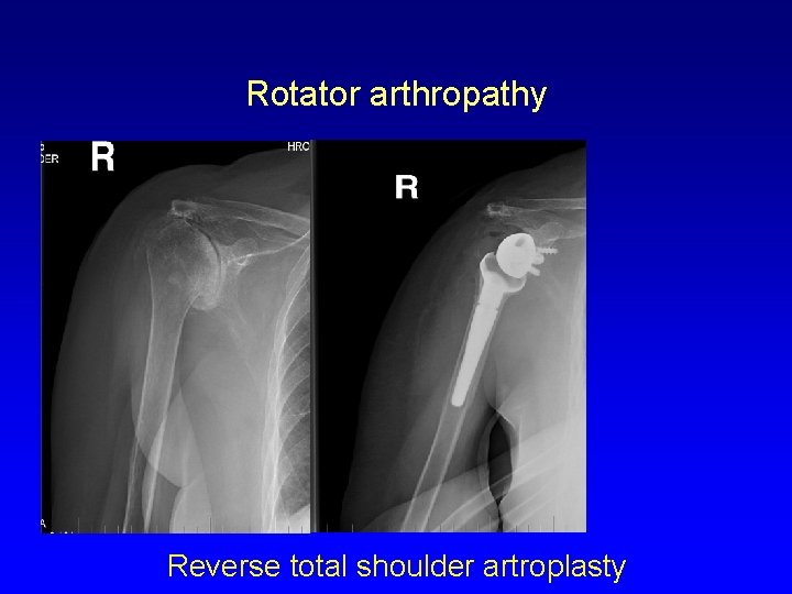 Rotator arthropathy Reverse total shoulder artroplasty 