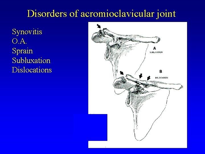 Disorders of acromioclavicular joint Synovitis O. A. Sprain Subluxation Dislocations 