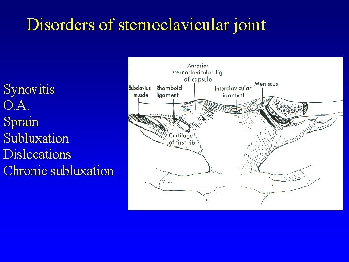 Disorders of sternoclavicular joint Synovitis O. A. Sprain Subluxation Dislocations Chronic subluxation 