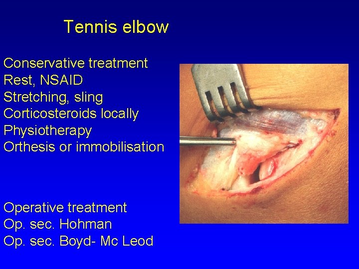 Tennis elbow Conservative treatment Rest, NSAID Stretching, sling Corticosteroids locally Physiotherapy Orthesis or immobilisation