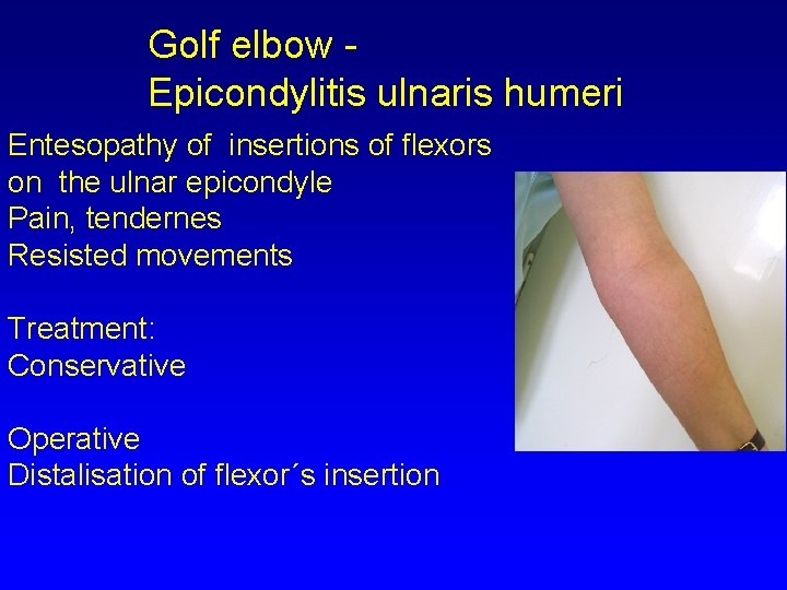 Golf elbow Epicondylitis ulnaris humeri Entesopathy of insertions of flexors on the ulnar epicondyle