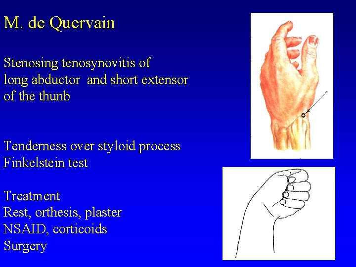 M. de Quervain Stenosing tenosynovitis of long abductor and short extensor of the thunb