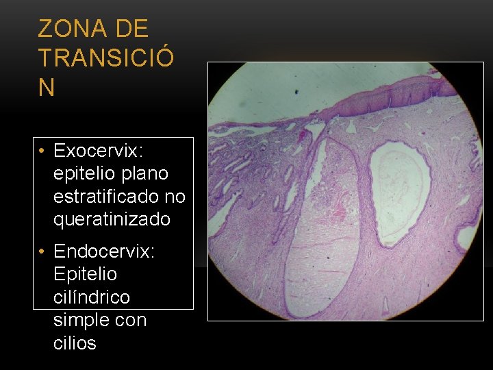 ZONA DE TRANSICIÓ N • Exocervix: epitelio plano estratificado no queratinizado • Endocervix: Epitelio