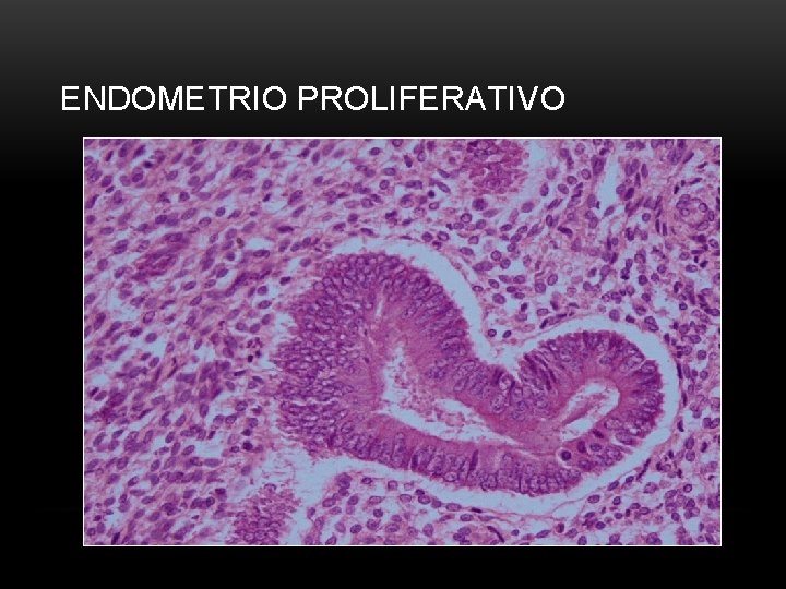 ENDOMETRIO PROLIFERATIVO 