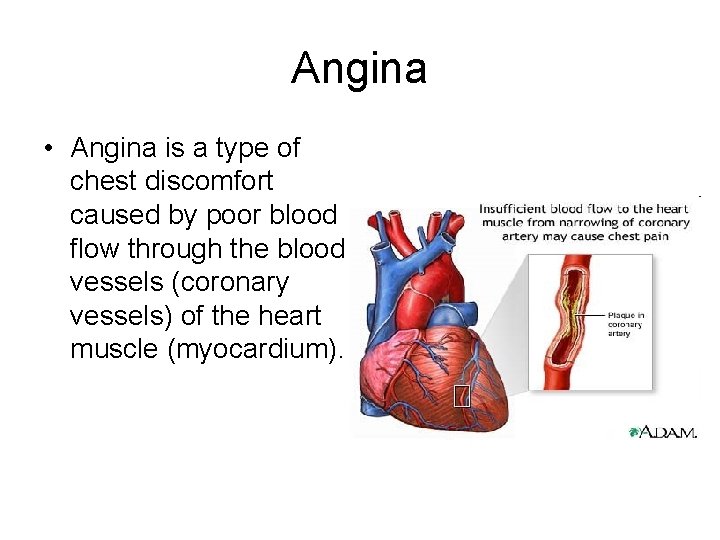 Angina • Angina is a type of chest discomfort caused by poor blood flow