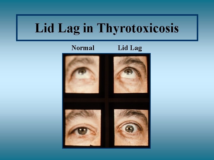 Lid Lag in Thyrotoxicosis Normal Lid Lag 
