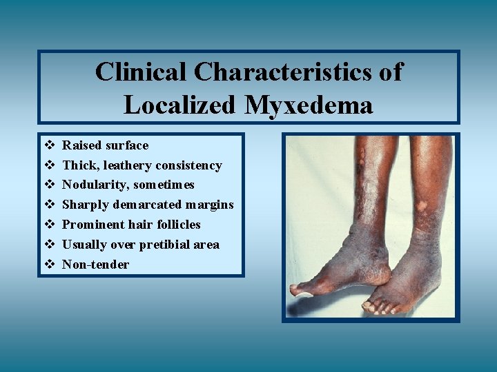Clinical Characteristics of Localized Myxedema v v v v Raised surface Thick, leathery consistency