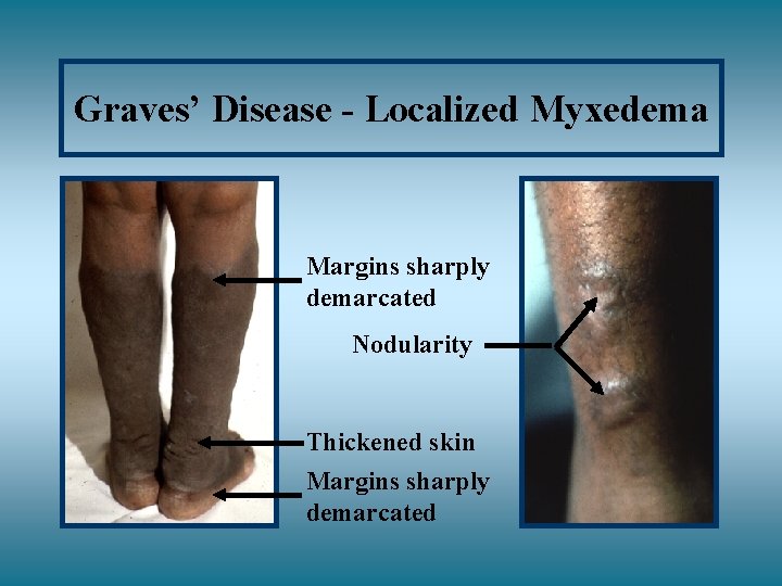Graves’ Disease - Localized Myxedema Margins sharply demarcated Nodularity Thickened skin Margins sharply demarcated