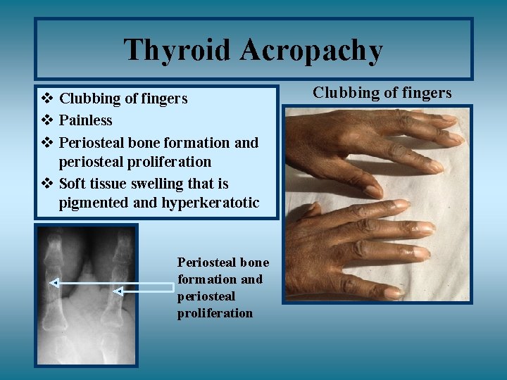Thyroid Acropachy v Clubbing of fingers v Painless v Periosteal bone formation and periosteal