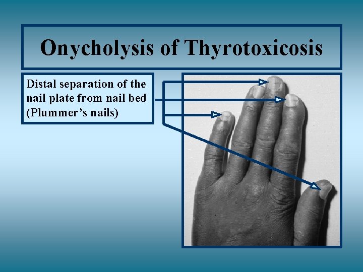Onycholysis of Thyrotoxicosis Distal separation of the nail plate from nail bed (Plummer’s nails)