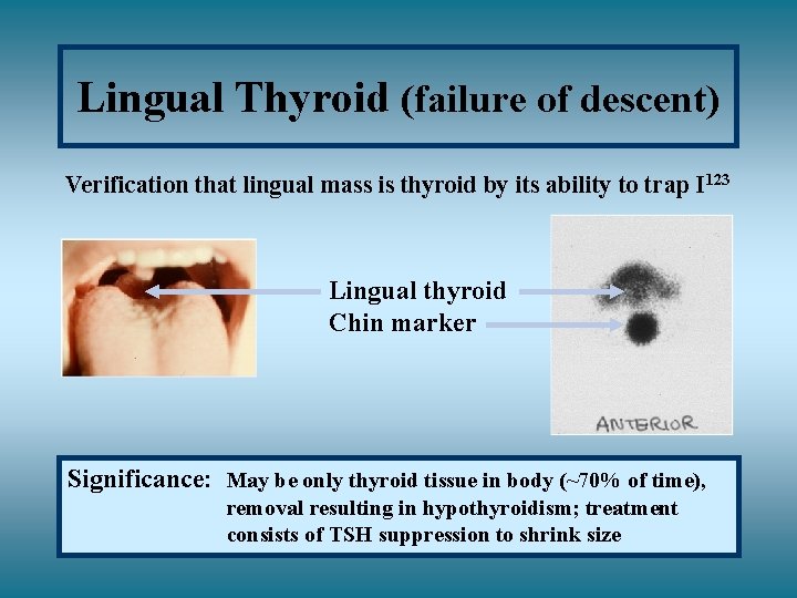 Lingual Thyroid (failure of descent) Verification that lingual mass is thyroid by its ability