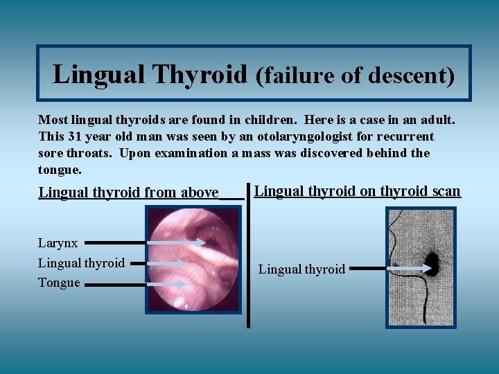 Lingual Thyroid (failure of descent) Most lingual thyroids are found in children. Here is