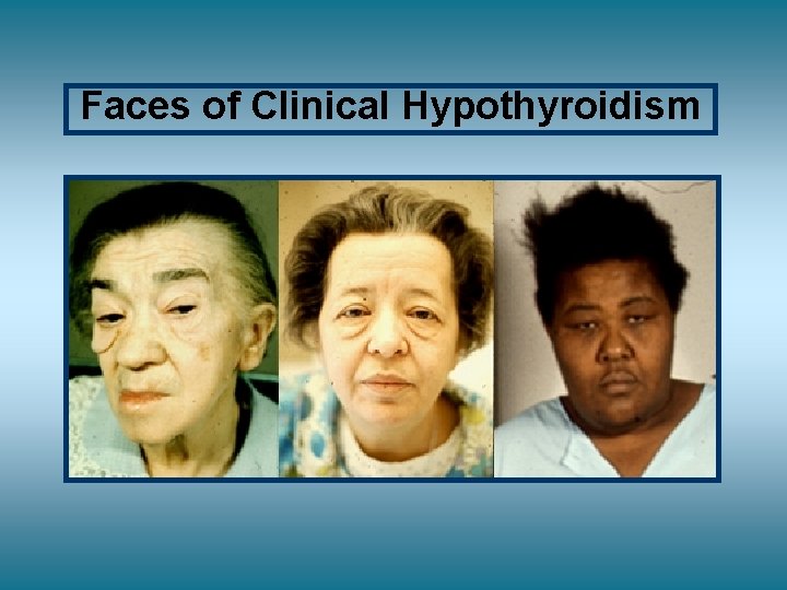 Faces of Clinical Hypothyroidism 