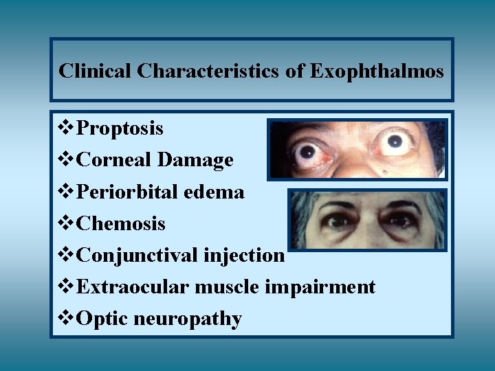 Clinical Characteristics of Exophthalmos v. Proptosis v. Corneal Damage v. Periorbital edema v. Chemosis
