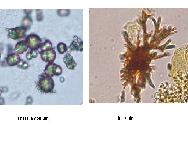 Kristal amonium bilirubin 