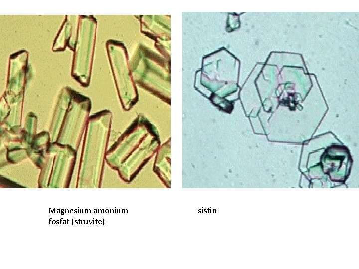 Magnesium amonium fosfat (struvite) sistin 