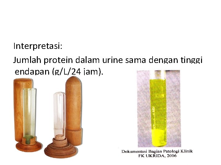 Interpretasi: Jumlah protein dalam urine sama dengan tinggi endapan (g/L/24 jam). 