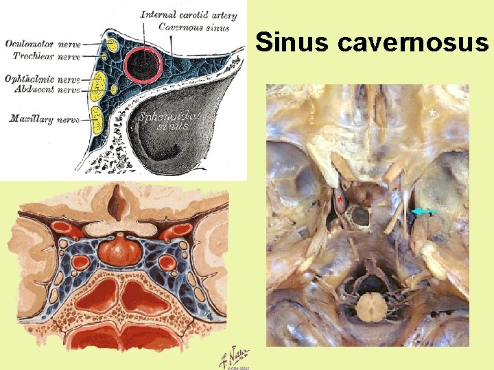 Sinus cavernosus Sinus cavernosus
