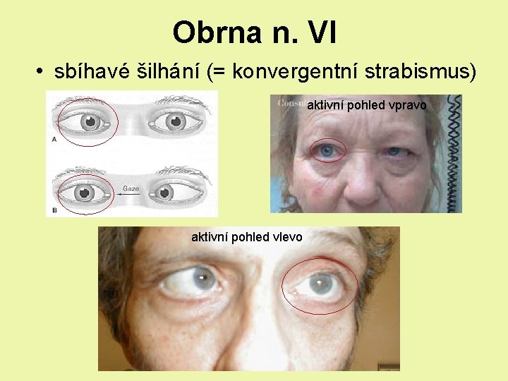 Obrna n. VI • sbíhavé šilhání (= konvergentní strabismus) aktivní pohled vpravo aktivní pohled Obrna n. VI • sbíhavé šilhání (= konvergentní strabismus) aktivní pohled vpravo aktivní pohled