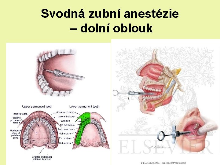 Svodná zubní anestézie – dolní oblouk Svodná zubní anestézie – dolní oblouk