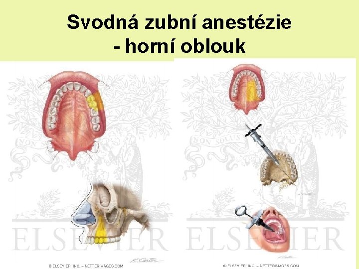 Svodná zubní anestézie - horní oblouk Svodná zubní anestézie - horní oblouk