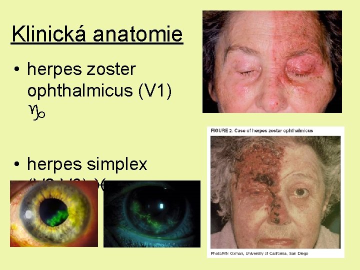 Klinická anatomie • herpes zoster ophthalmicus (V 1) • herpes simplex (V 2, V Klinická anatomie • herpes zoster ophthalmicus (V 1) • herpes simplex (V 2, V