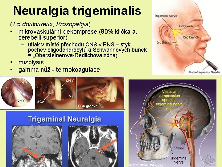 Neuralgia trigeminalis (Tic douloureux; Prosopalgia) • mikrovaskulární dekomprese (80% klička a. cerebelli superior) – Neuralgia trigeminalis (Tic douloureux; Prosopalgia) • mikrovaskulární dekomprese (80% klička a. cerebelli superior) –