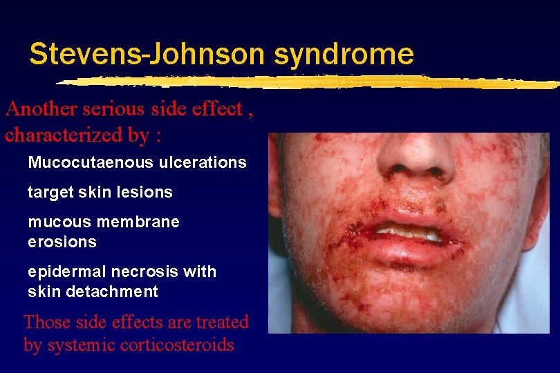 Stevens-Johnson syndrome Another serious side effect , characterized by : Mucocutaenous ulcerations target skin Stevens-Johnson syndrome Another serious side effect , characterized by : Mucocutaenous ulcerations target skin
