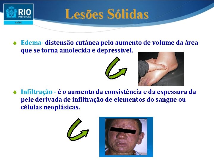 Lesões Sólidas S Edema- distensão cutânea pelo aumento de volume da área que se Lesões Sólidas S Edema- distensão cutânea pelo aumento de volume da área que se