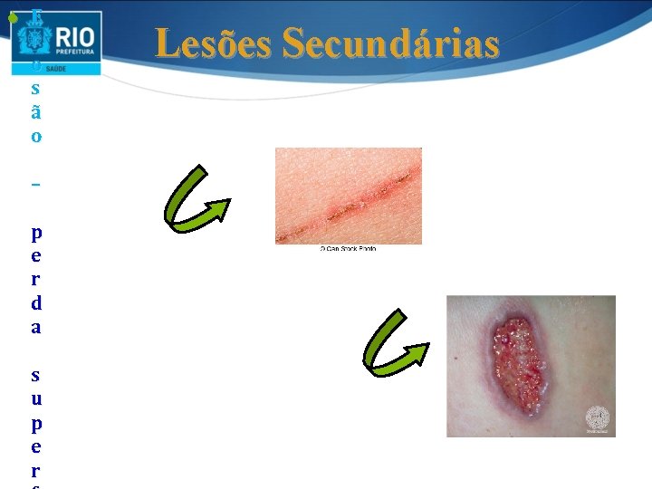 S E r o s ã o – p e r d a s S E r o s ã o – p e r d a s