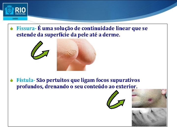 S Fissura- É uma solução de continuidade linear que se estende da superfície da S Fissura- É uma solução de continuidade linear que se estende da superfície da