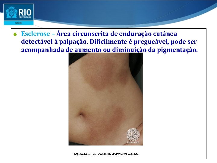 S Esclerose – Área circunscrita de enduração cutânea detectável à palpação. Dificilmente é pregueável, S Esclerose – Área circunscrita de enduração cutânea detectável à palpação. Dificilmente é pregueável,