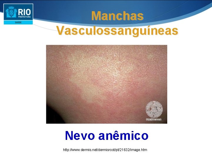 Manchas Vasculossanguíneas Nevo anêmico http: //www. dermis. net/dermisroot/pt/21632/image. htm Manchas Vasculossanguíneas Nevo anêmico http: //www. dermis. net/dermisroot/pt/21632/image. htm
