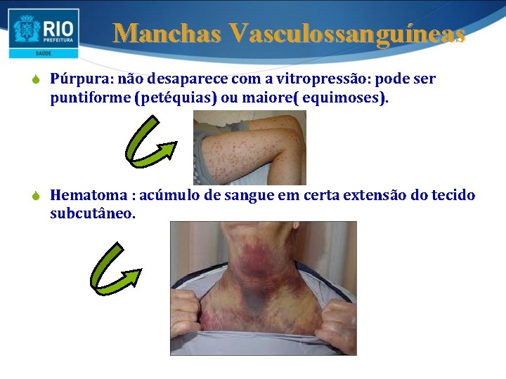 Manchas Vasculossanguíneas S Púrpura: não desaparece com a vitropressão: pode ser puntiforme (petéquias) ou Manchas Vasculossanguíneas S Púrpura: não desaparece com a vitropressão: pode ser puntiforme (petéquias) ou