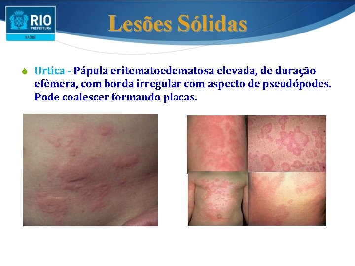Lesões Sólidas S Urtica - Pápula eritematoedematosa elevada, de duração efêmera, com borda irregular Lesões Sólidas S Urtica - Pápula eritematoedematosa elevada, de duração efêmera, com borda irregular