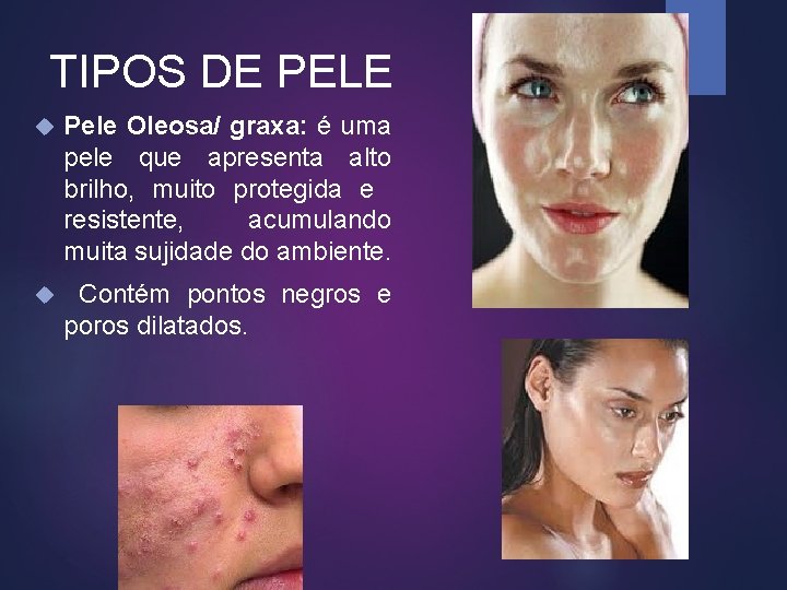 TIPOS DE PELE Pele Oleosa/ graxa: é uma pele que apresenta alto brilho, muito