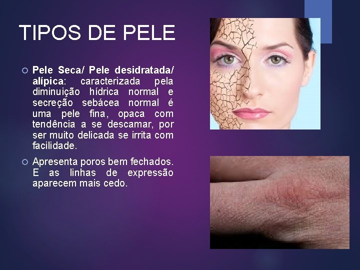 TIPOS DE PELE Pele Seca/ Pele desidratada/ alípica: caracterizada pela diminuição hídrica normal e